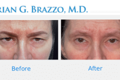 ble-befroe-and-after