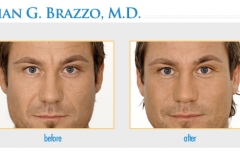 bna-restylane4