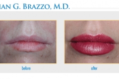 bna-restylane6