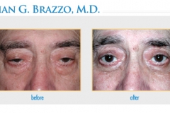 bna-ptosis2