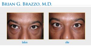 Eyelid Rejuvenation performed by New York City Eyelid Surgeon Dr. Brian Brazzo