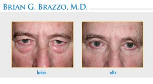 Blepharoplasty performed by New York City Eyelid Surgeon Dr. Brian Brazzo