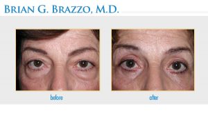 Blepharoplasty Manhattan, New York