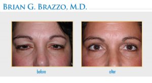 Eyelid Rejuvenation Manhattan, New York