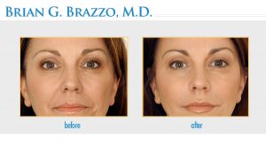 Dermal Fillers Manhattan, New York