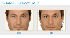 Nonsurgical Facial Rjuventation Manhattan, New York