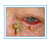 Skin Cancer Treatments around the Eye Manhattan, New York