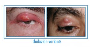 Chalazion Surgery New York City - Stye Treatment Manhattan - Dr. Brazzo