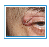 Eye Skin Cancer Treatments Manhattan, New York