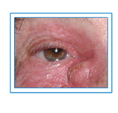 Tear Duck Blockage Treatment in New York City by Dr. Brian Brazzo